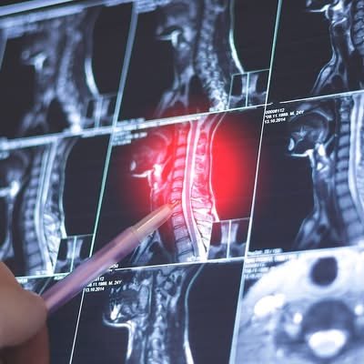 Mieux détecter le rhumatisme psoriasique axial